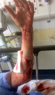 Pic: Sharon's arm dog bite