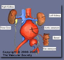 Abdominal aortic aneurysm diagram