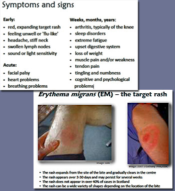 Pic: Lyme Disease symptoms graphic